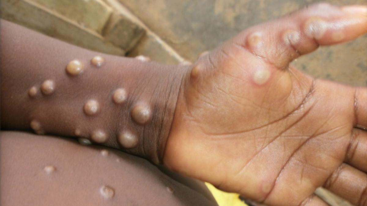 Monkeypox New Case : राजधानी से सामने आया मंकिपॉक्स का तीसरा मामला, अबतक देशभर में 8 मरीजों की पुष्टि