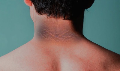 Health Tips : क्या आपके गर्दन पर है ये निशान, तो हो जाइए सावधान, इस गंभीर बीमारी के है संकेत