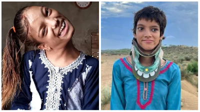Miracle : पाकिस्तानी लड़की के लिए देवदूत बने भारतीय डॉक्टर, दी नई जिंदगी, 90 डिग्री में घुमा हुआ था चेहरा इस तरह किया इलाज...